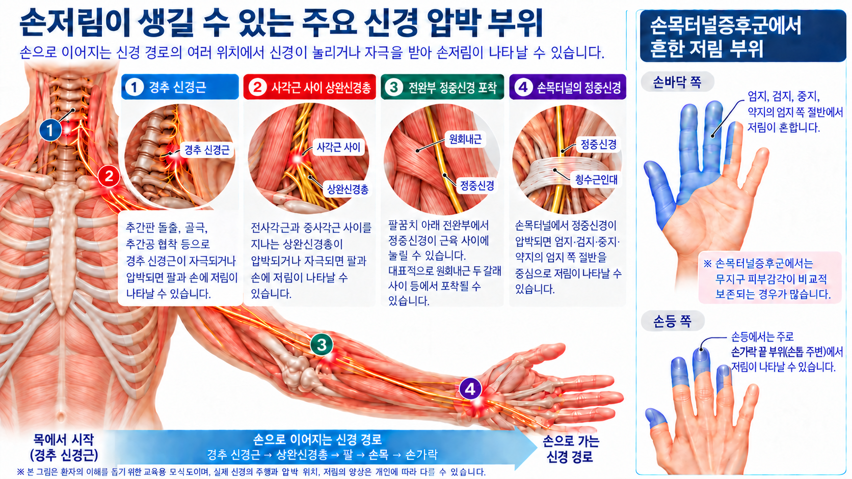 밤에 손이 저리고 아픈 이유는? 손목터널증후군일까요?